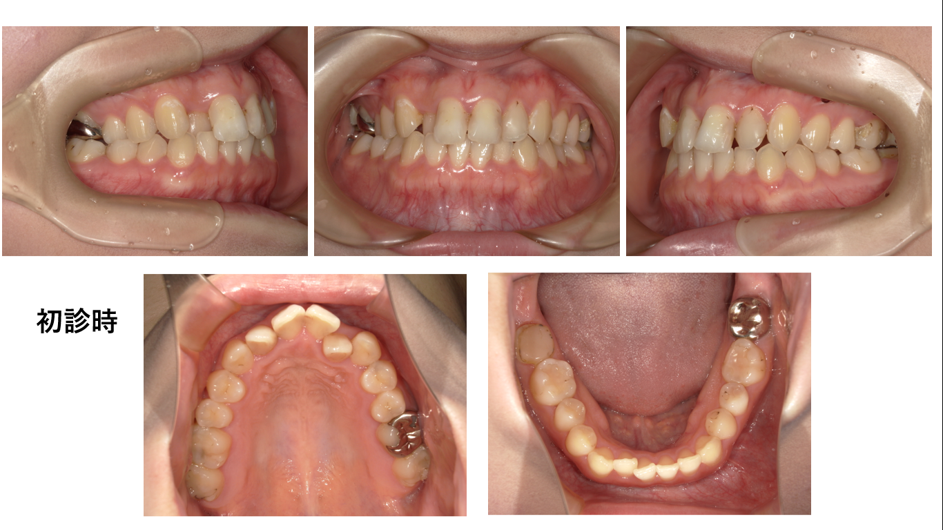 矯正症例142、AngleⅠ級、上顎前突
