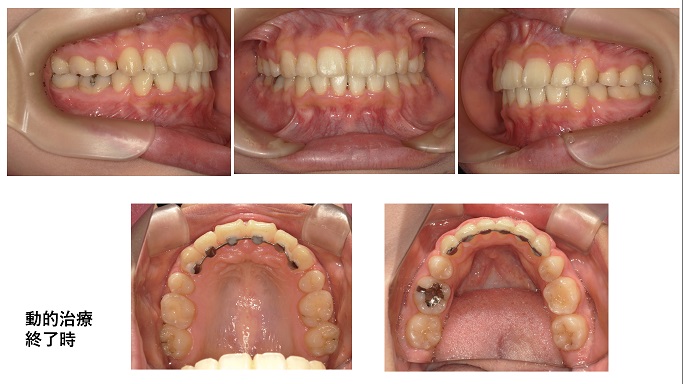 矯正症例92　AngleⅠ級歯槽性上下顎前突　