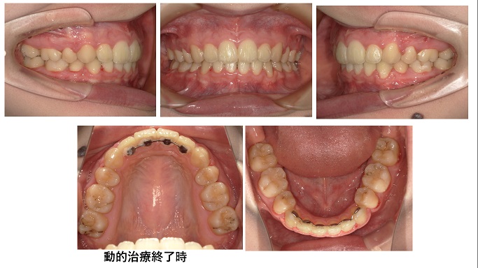 矯正症例88　上下顎前突　秋田市、潟上市、能代市、北秋田市、大館市