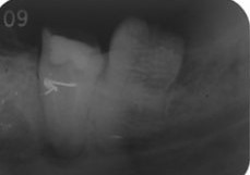 インプラントする場合の歯科医院選び。抜く必要のない歯を抜歯してインプラント