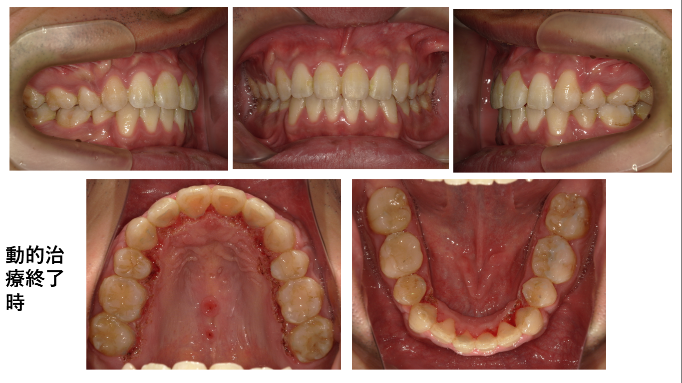 矯正症例 140 AngleⅠ級上下顎前突、舌側矯正