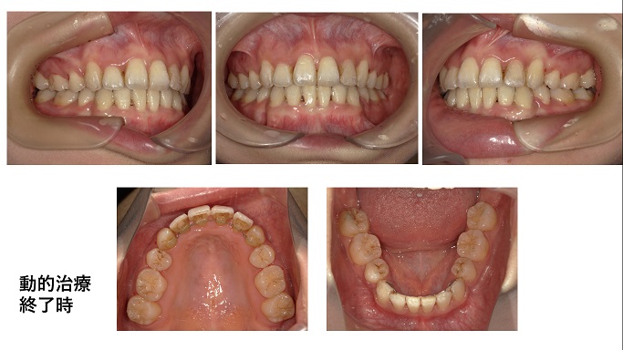 矯正症例96 下顎前突傾向を伴う AngleⅠ級叢生、能代市、秋田市、北秋田市、大館市