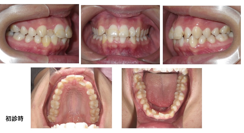 矯正症例94ハーフリンガル症例　叢生を伴うAngleⅠ級上下顎前突、裏側矯正、能代市、北秋田市、大館市