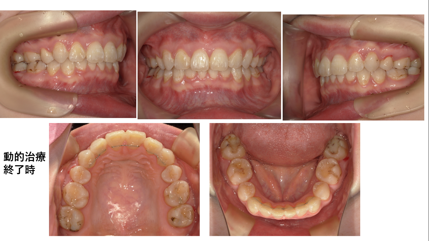 矯正症例144 AngleⅡ級2類