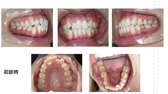 矯正症例78　AngleⅠ級叢生　舌側矯正 裏側矯正　秋田市　北秋田市　能代市　大館市