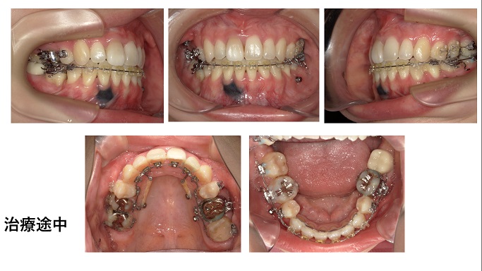 矯正症例87　上下顎前突　ハーフリンガル 裏側矯正　能代市、大館市、潟上市、北秋田市、秋田市