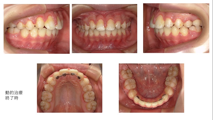 矯正症例７９ 上顎左側2番の先天性欠如を伴うAngleⅡ級1類上顎前突