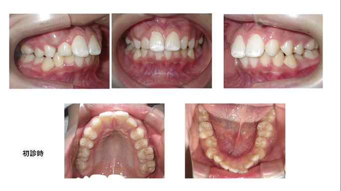 矯正症例７９ 上顎左側2番の先天性欠如を伴うAngleⅡ級1類上顎前突