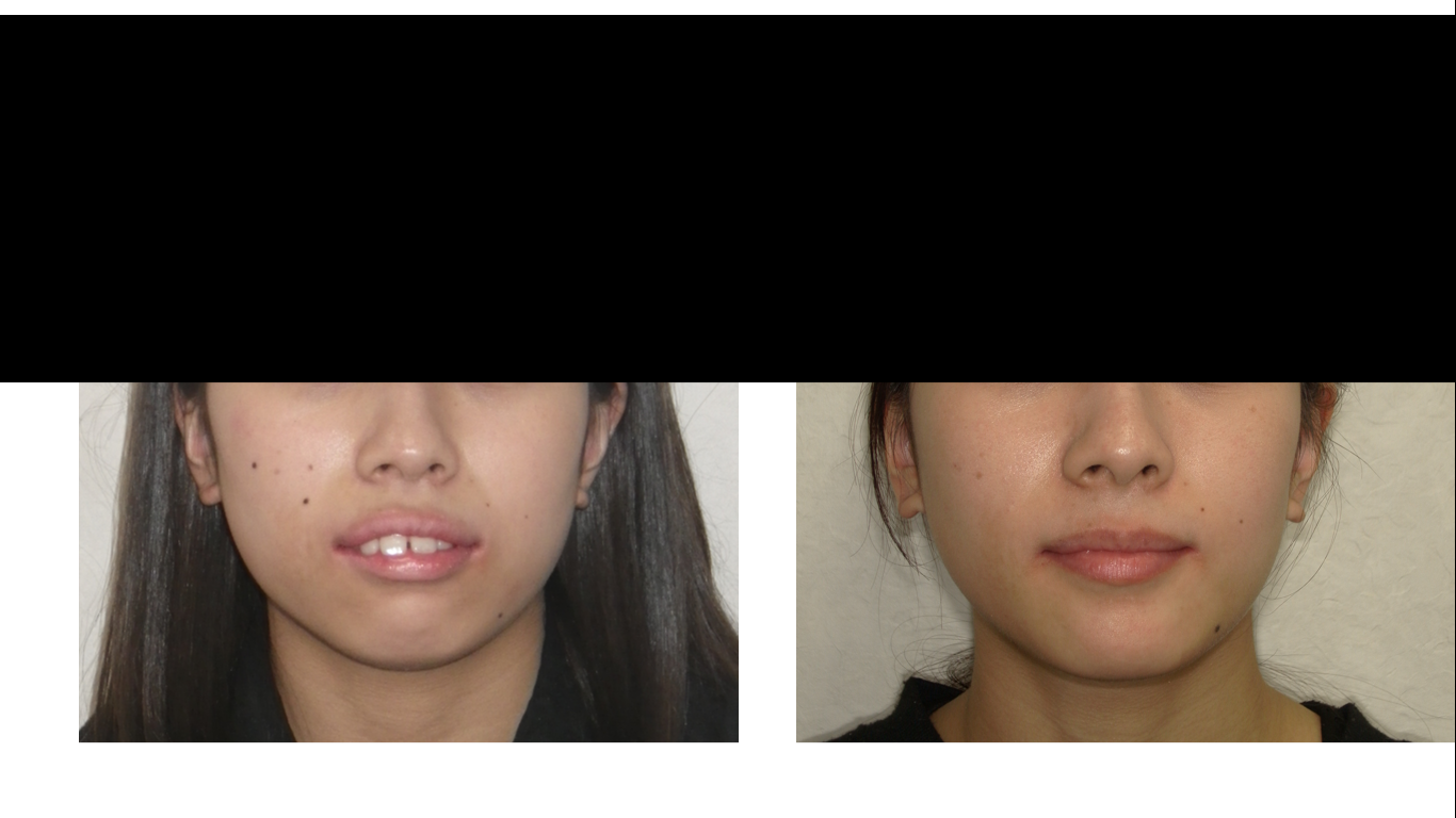 矯正症例138 AngleⅡ級1類 上顎前突