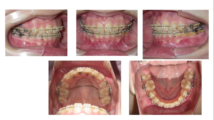 矯正症例63　AngleclassⅠ上顎前突　叢生,能代市,北秋田市,大館市