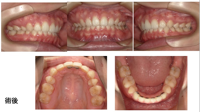 矯正症例82　上顎前突　叢生　ハーフリンガル  裏側矯正 能代市 北秋田市　大館市　北秋田市　潟上市　秋田市