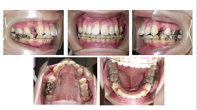 矯正症例95　ハーフリンガル症例AngleⅠ級上顎前突、舌側矯正、裏側矯正、北秋田市、大館市、能代市、秋田市