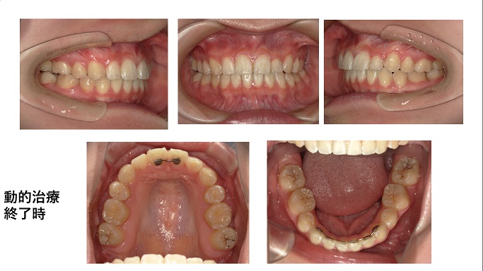 矯正症例93　AngleⅡ級叢生 秋田市、北秋田市、能代市、大館市