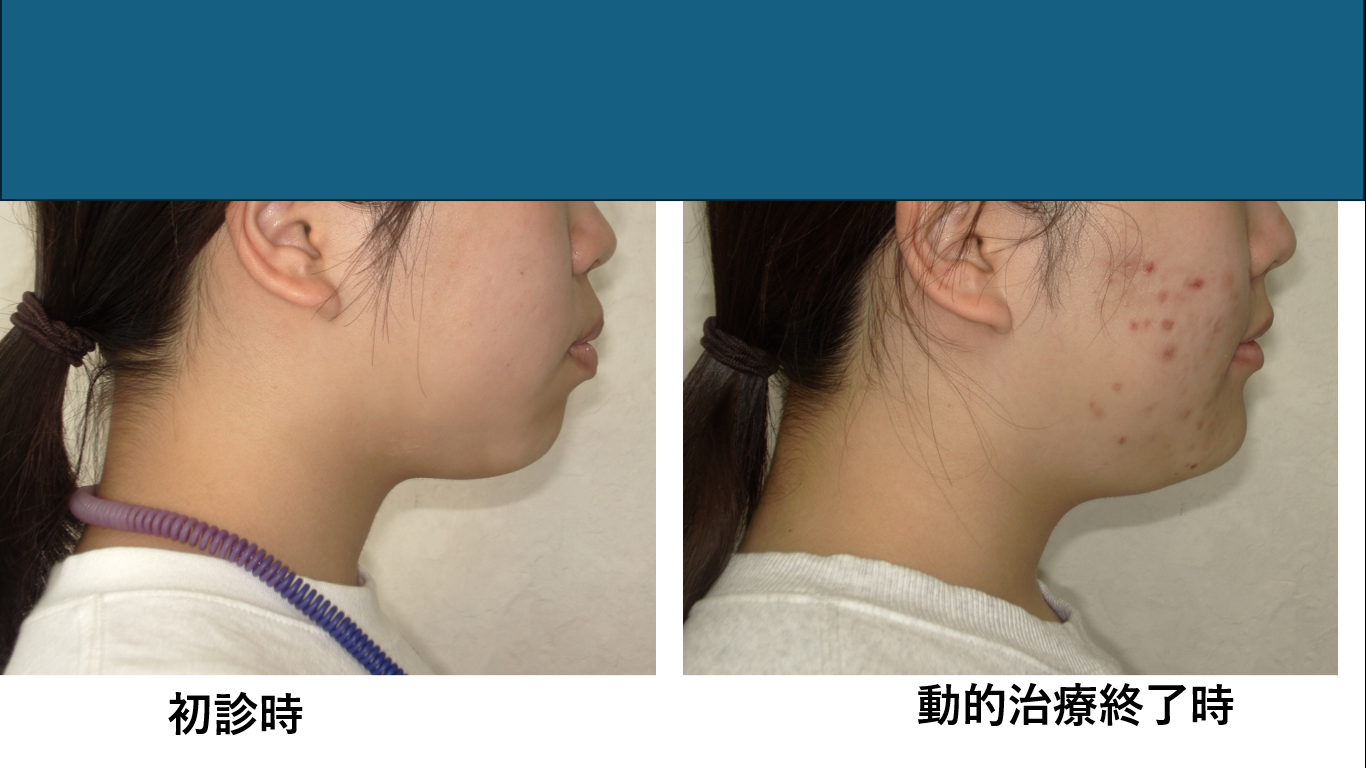 矯正症例141 AngleⅠ級 上下顎前突、ガミースマイル、口ごぼ