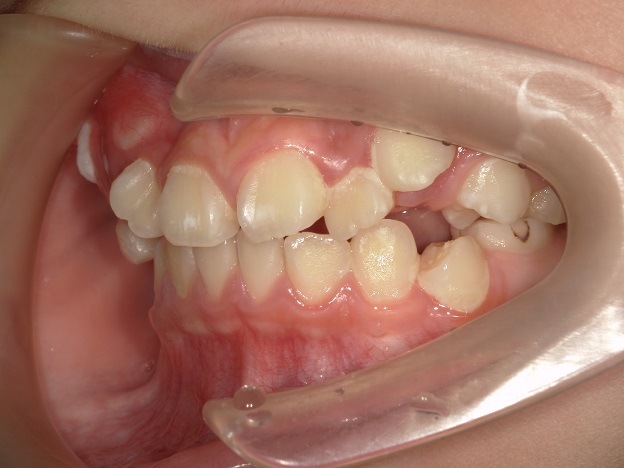 歯列矯正開始時期、子供の矯正は何歳で開始か？9歳で歯列矯正開始？
