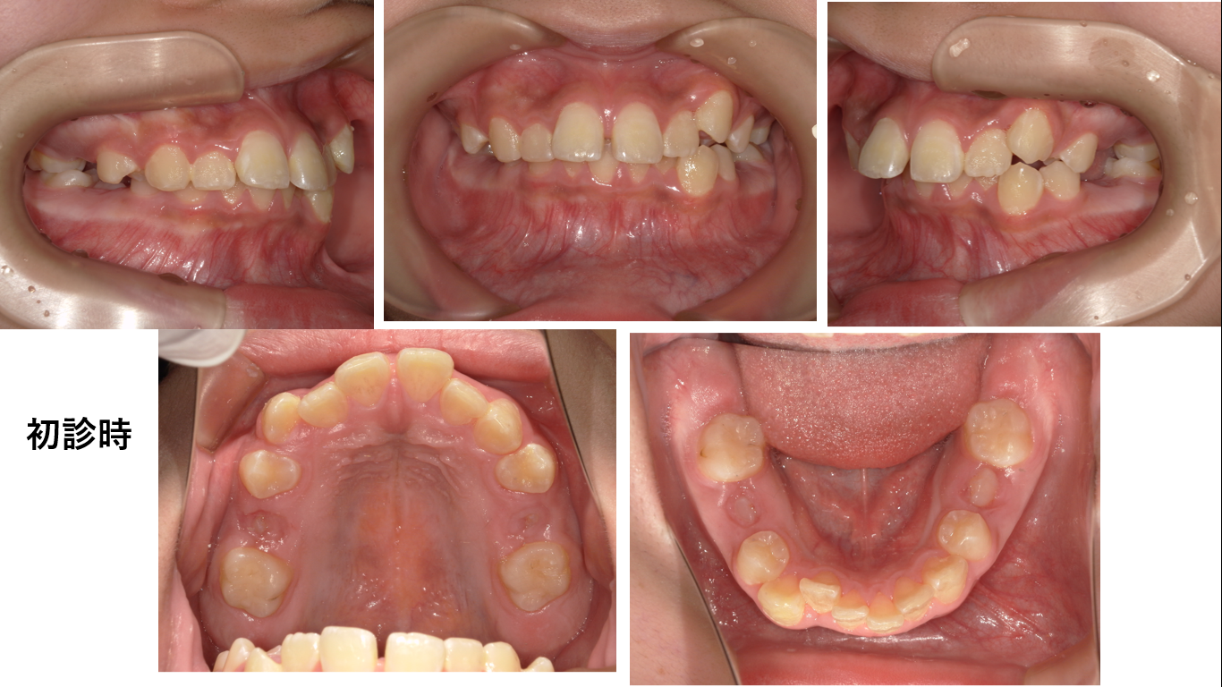 矯正症例149　AngleⅠ級上顎前突