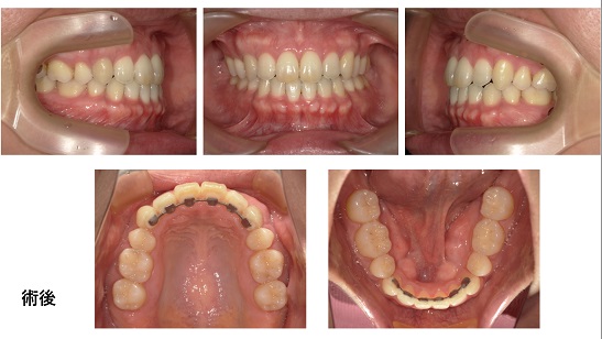 矯正症例81　上下顎前突　裏側矯正 舌側矯正 能代市　北秋田市　大館市　秋田市