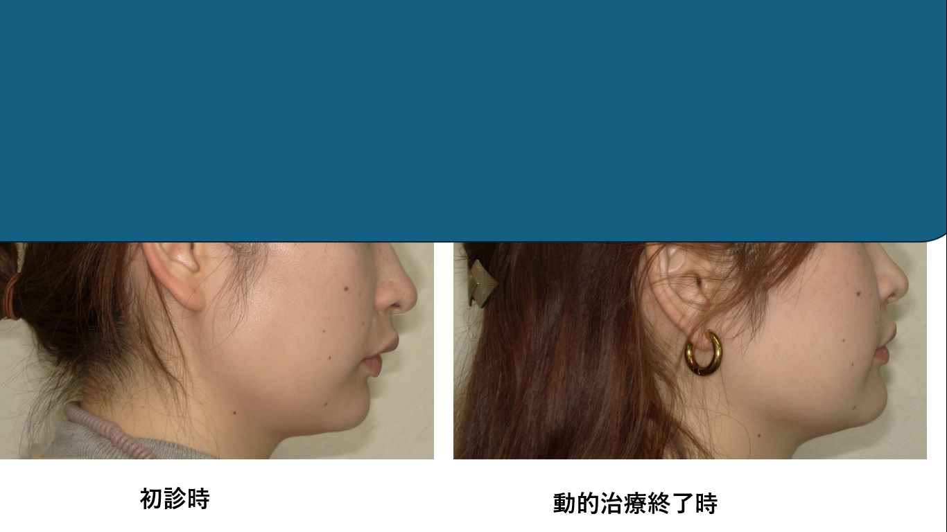 矯正症例144 AngleⅡ級2類