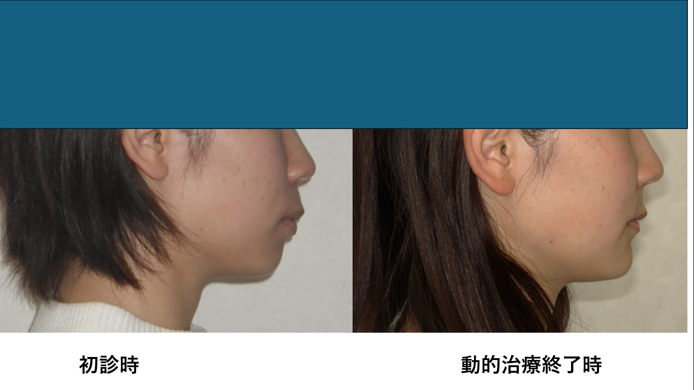 矯正症例127 AngleⅡ級 上下顎前突、 舌側矯正 能代市、北秋田市、大館市、秋田市