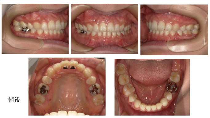 矯正症例86上下顎前突,やり直しの矯正、大館市,北秋田市,能代市、潟上市、秋田市、インチキでたらめ矯正