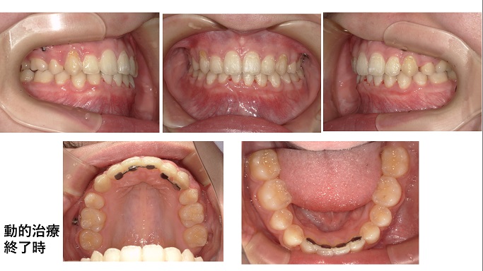 矯正症例76　Angle classⅡdiv１　上顎前突　過蓋咬合　下顎3本切歯症例　