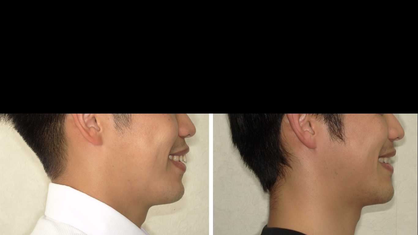 矯正症例 140 AngleⅠ級上下顎前突、舌側矯正