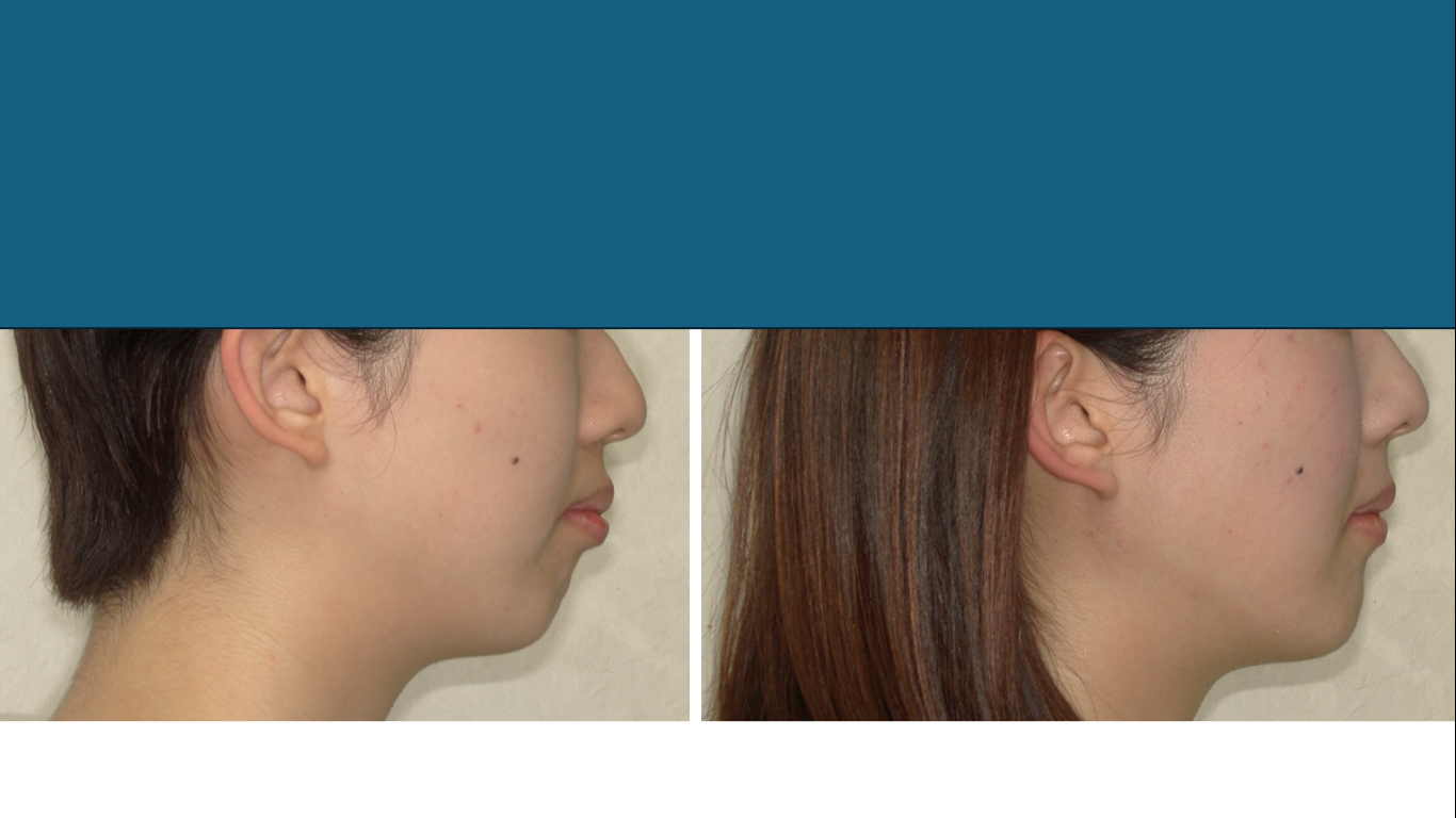 矯正症例147 AngleⅠ級 上顎前突　裏側矯正　舌側矯正