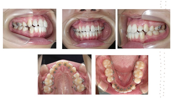 矯正症例78　AngleⅠ級叢生　舌側矯正 裏側矯正　秋田市　北秋田市　能代市　大館市
