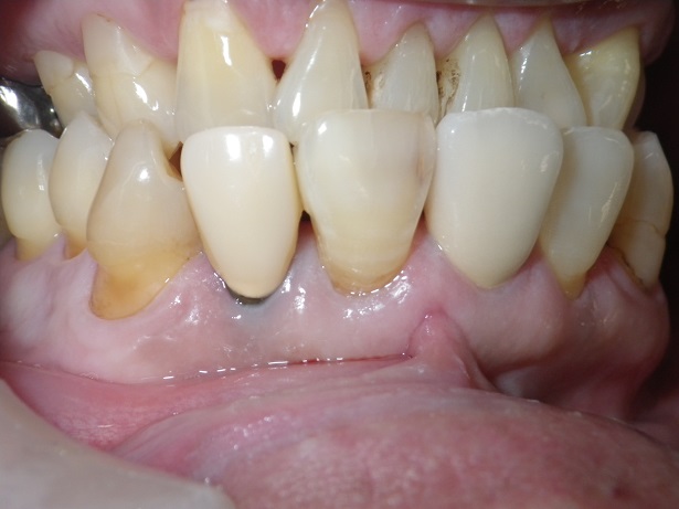 定期検診と虫歯の診断 小窩裂溝齲蝕 根面齲蝕 非活動性齲蝕 ブログ 能代で歯列矯正 インプラント治療を行なうならよつじ歯科医院