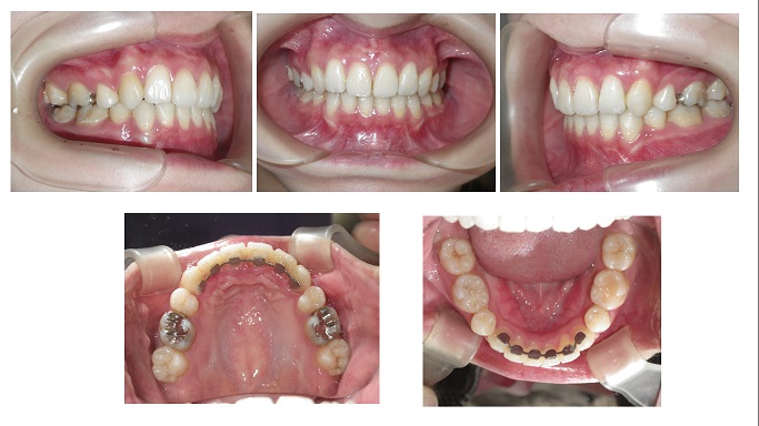 矯正症例71　Angle Ⅰ級叢生　ハーフリンガル症例