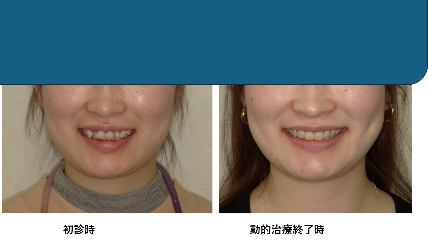 矯正症例144 AngleⅡ級2類