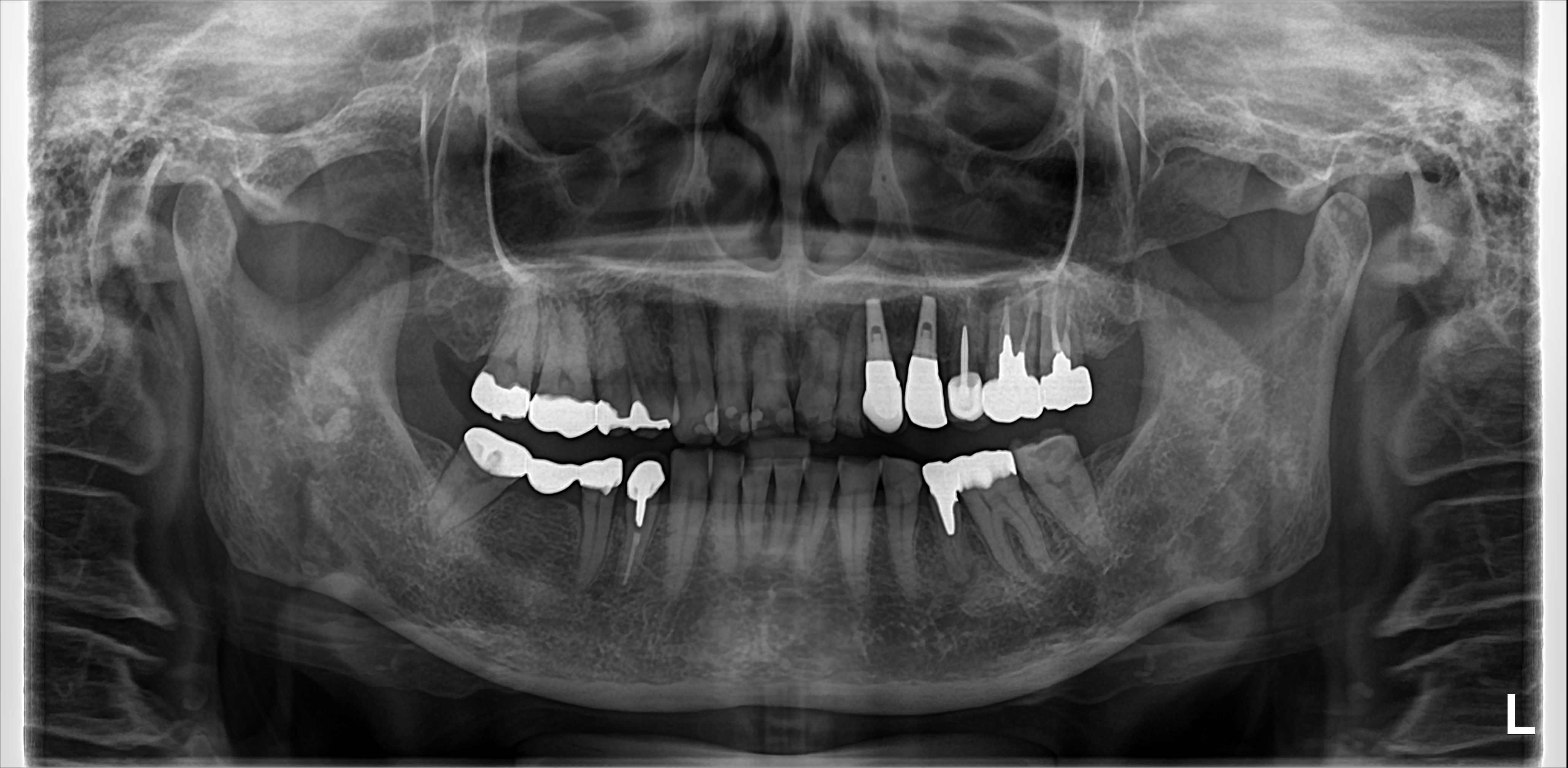 歯ぎしりのある患者にインプラントをして14年経過