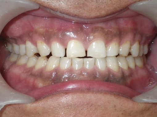 ウオーキングブリーチ 黒い歯のホワイトニング 神経が死んだ歯のホワイトニング