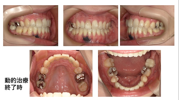 矯正症例87　上下顎前突　ハーフリンガル 裏側矯正　能代市、大館市、潟上市、北秋田市、秋田市
