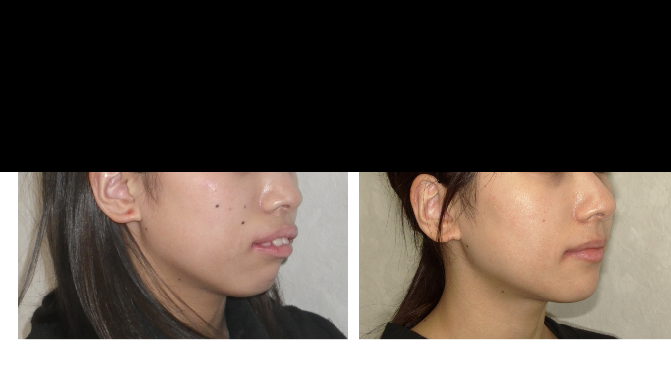 矯正症例138 AngleⅡ級1類 上顎前突