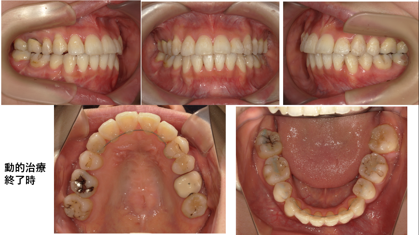 矯正症例139  AngleⅠ級叢生、下顎8番埋伏歯の牽引