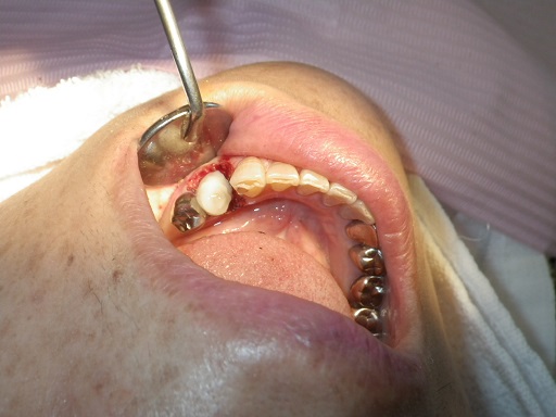 できるだけ歯を残します。抜歯しなければいけないと言われても残せるばあいがあります。炭酸ガスレーザーの使用法