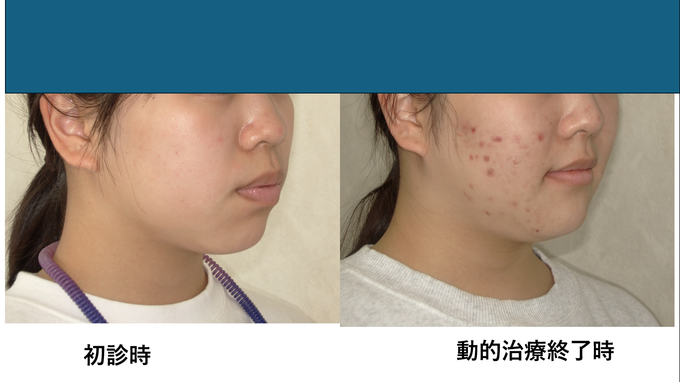 矯正症例141 AngleⅠ級 上下顎前突、ガミースマイル、口ごぼ