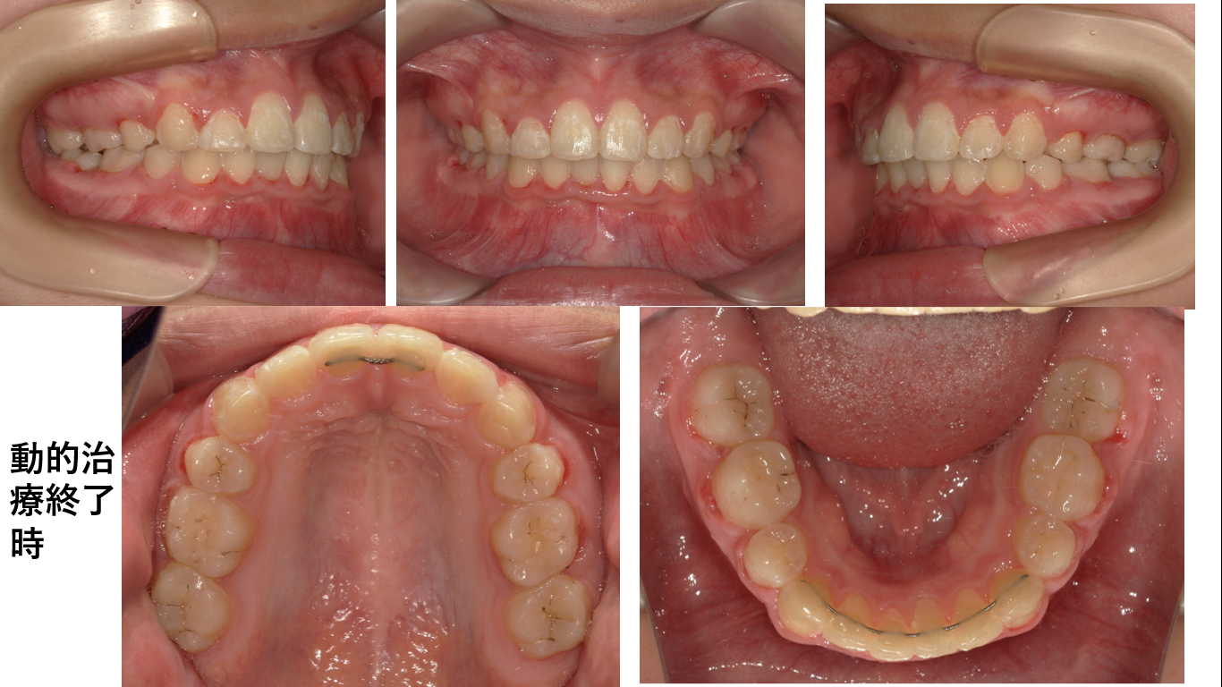 矯正症例149　AngleⅠ級上顎前突