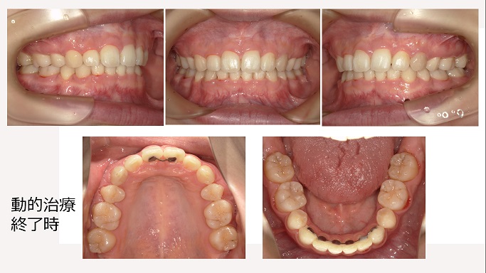 矯正症例91　AngleⅠ級上顎前突　秋田市、潟上市、能代市、北秋田市、大館市