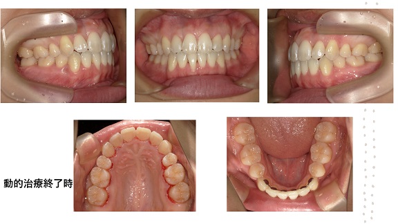 矯正症例78　AngleⅠ級叢生　舌側矯正 裏側矯正　秋田市　北秋田市　能代市　大館市