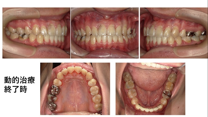 矯正症例95　ハーフリンガル症例AngleⅠ級上顎前突、舌側矯正、裏側矯正、北秋田市、大館市、能代市、秋田市