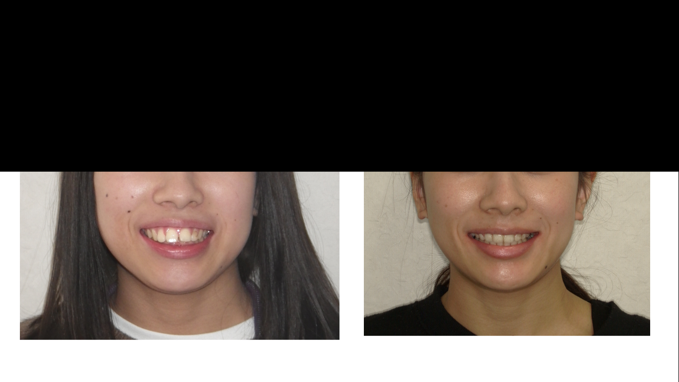 矯正症例138 AngleⅡ級1類 上顎前突