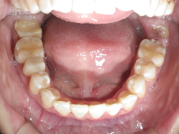インチキデタラメ矯正3、非抜歯拡大矯正