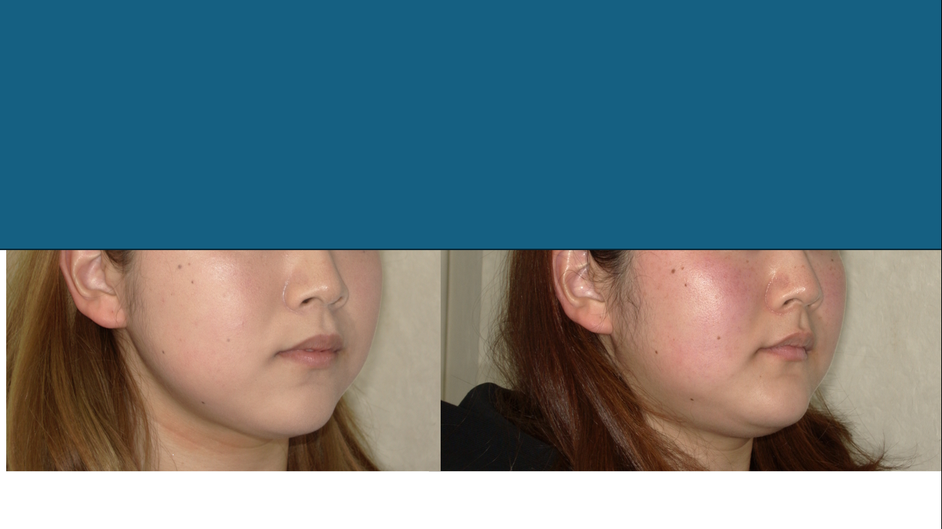 矯正症例142、AngleⅠ級、上顎前突