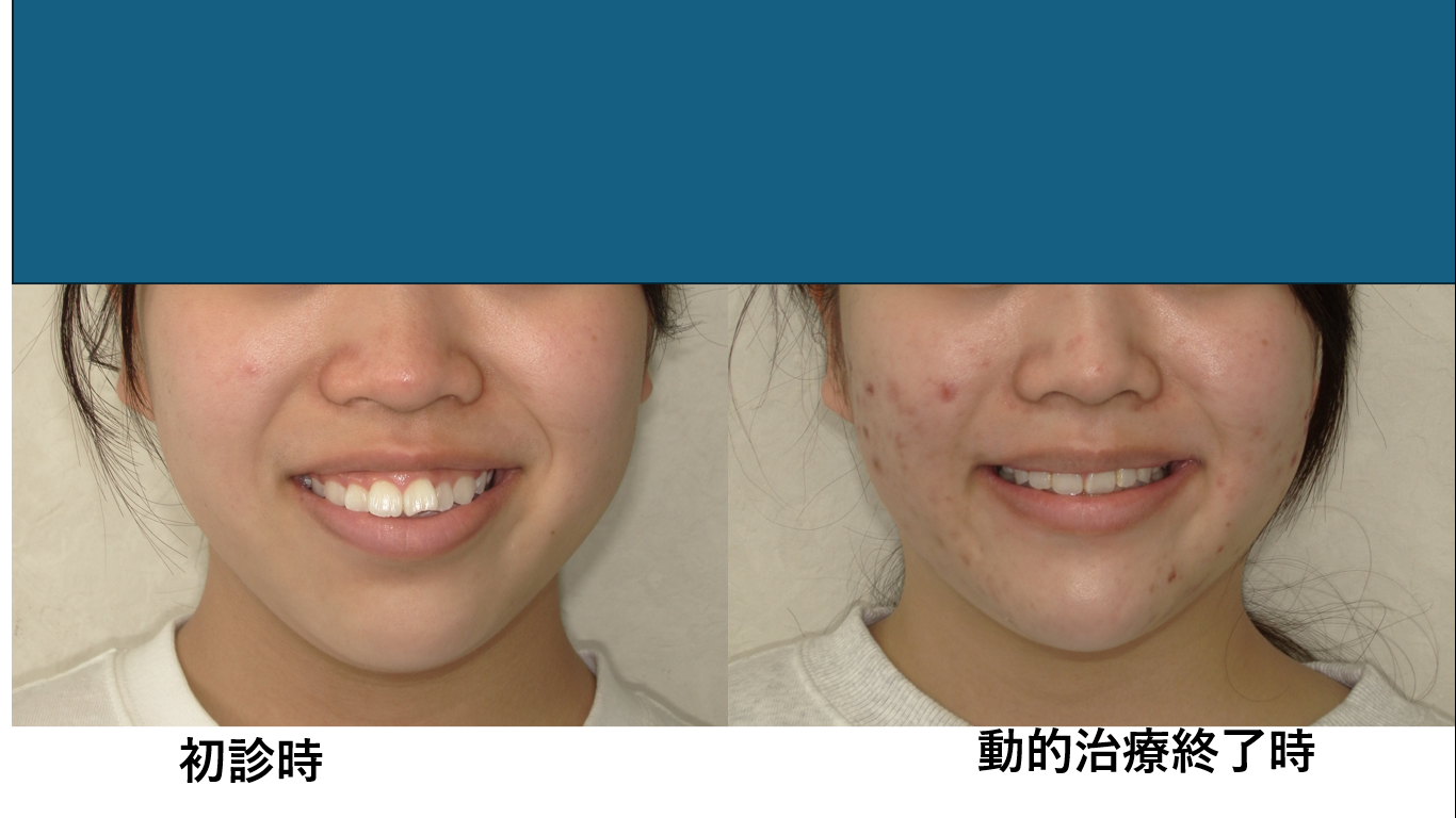 矯正症例141 AngleⅠ級 上下顎前突、ガミースマイル、口ごぼ