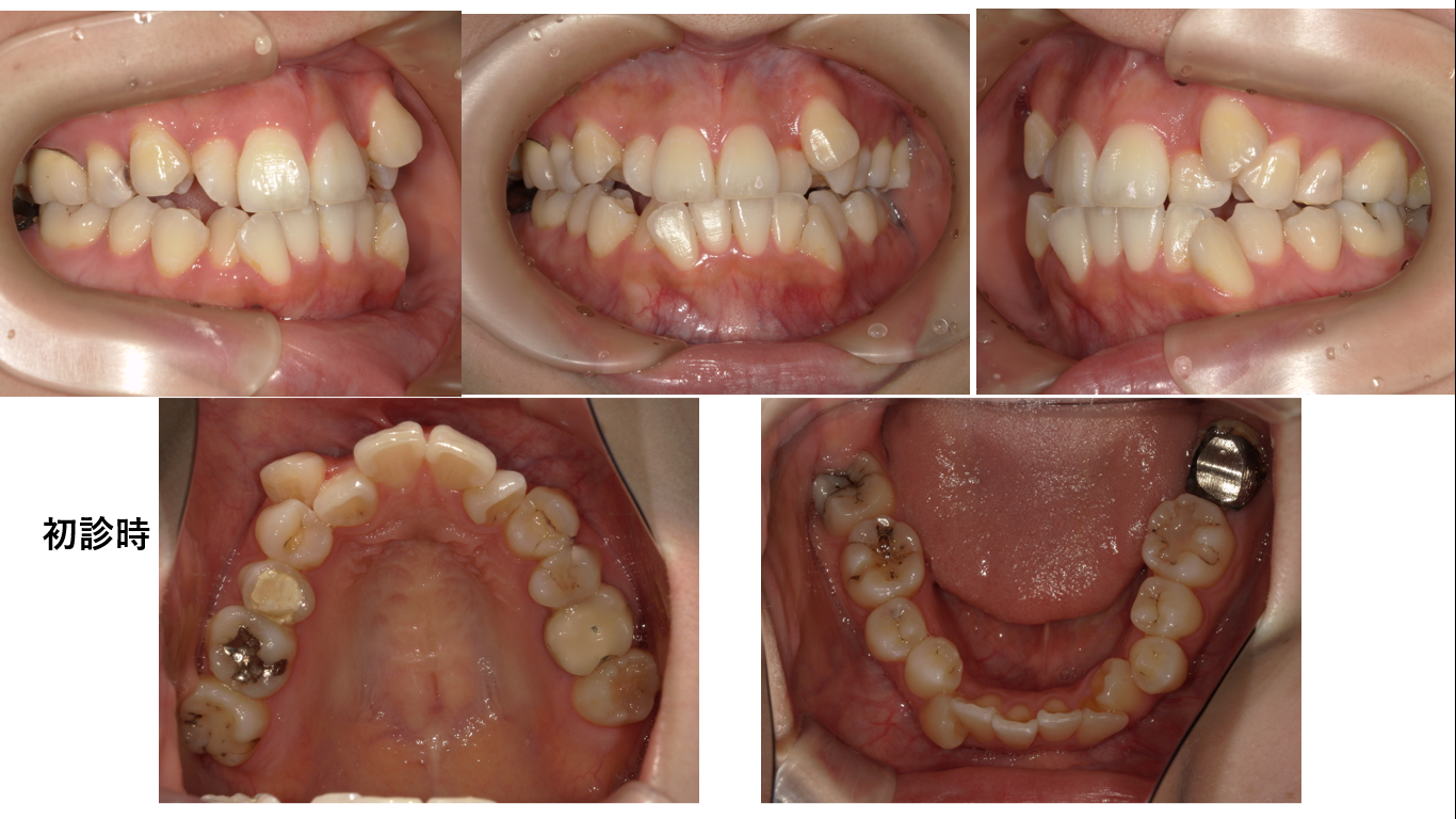 矯正症例139  AngleⅠ級叢生、下顎8番埋伏歯の牽引
