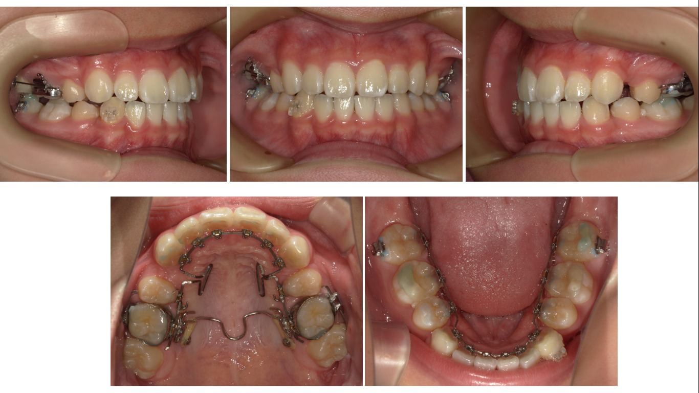 矯正症例148　AngleⅠ級上顎前突、裏側矯正、舌側矯正