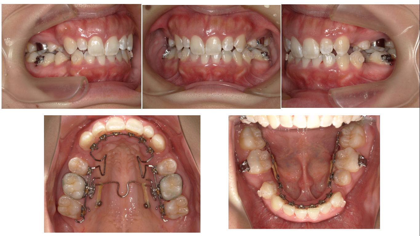 矯正症例143 AngleⅡ級2類、裏側矯正、舌側矯正