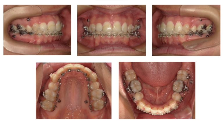 矯正症例94ハーフリンガル症例　叢生を伴うAngleⅠ級上下顎前突、裏側矯正、能代市、北秋田市、大館市